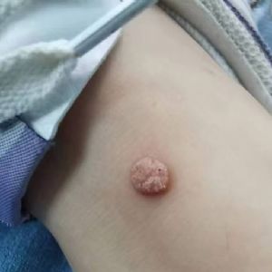 跖疣刺瘊