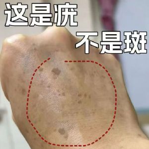 扁平疣